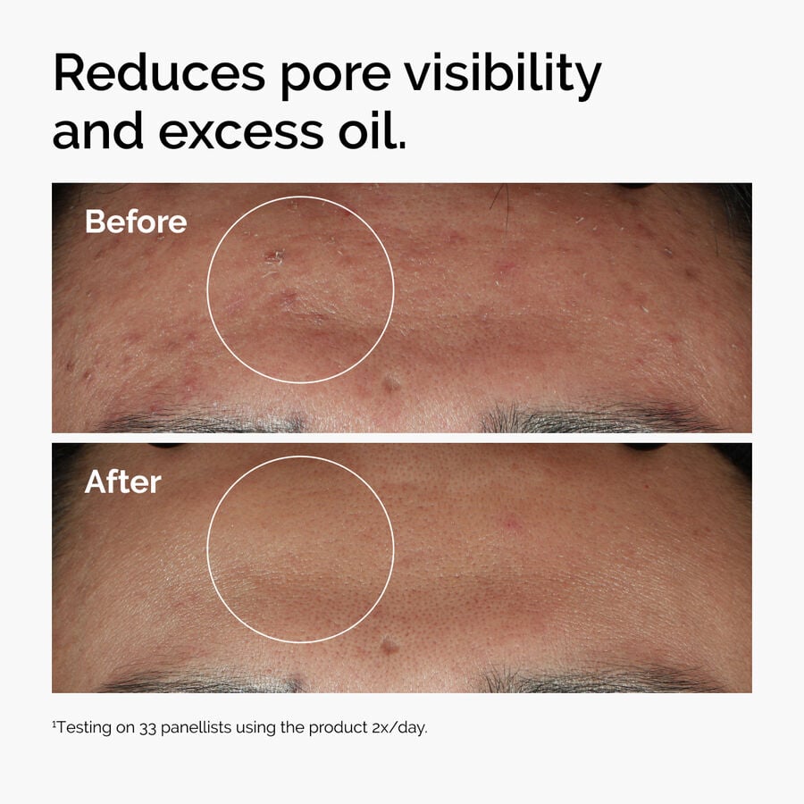 niacinamide-10-zinc-1-d1 ord-niacinamide-zinc-blemish-serum-before-after-pores.jpg