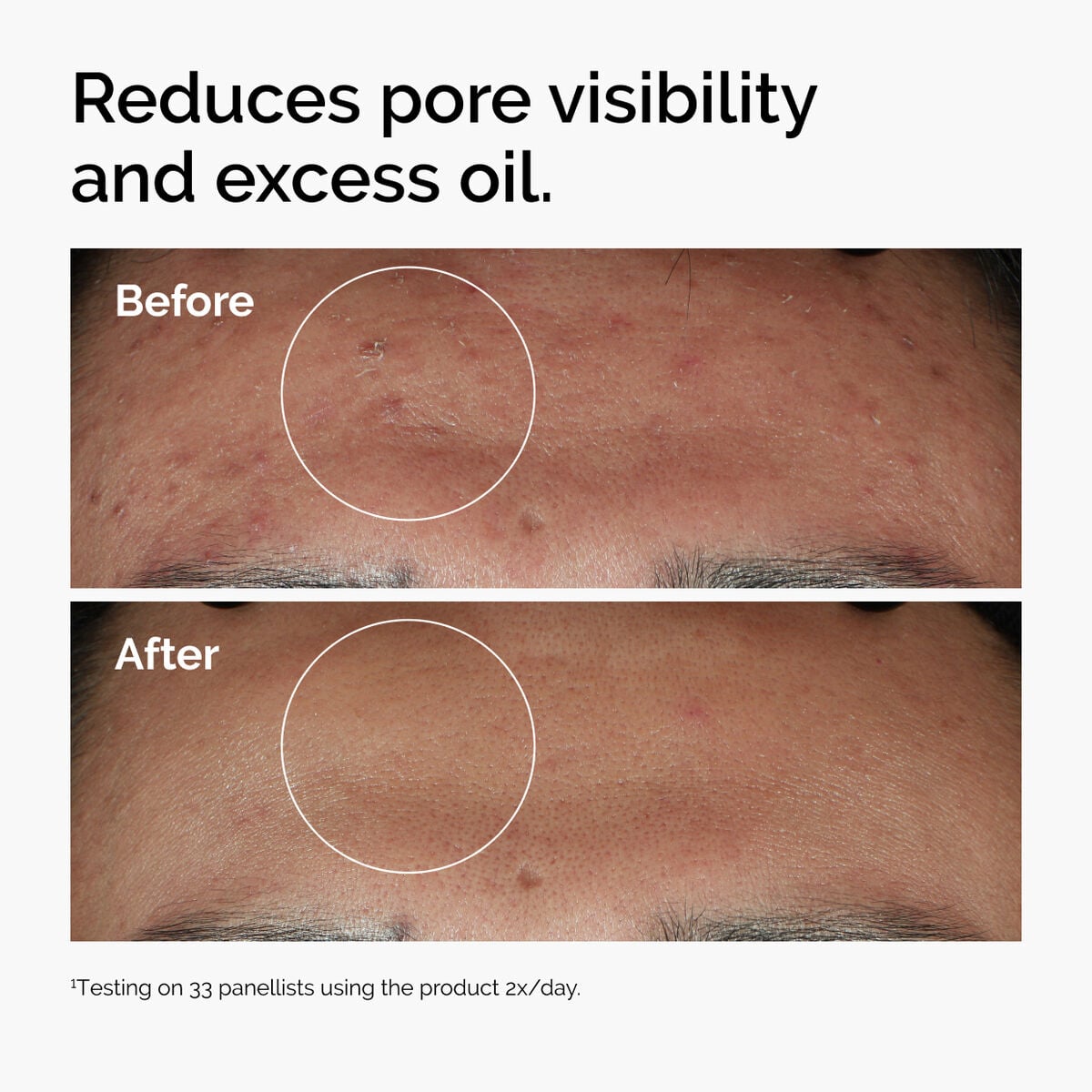 niacinamide-10-zinc-1-d1 ord-niacinamide-zinc-blemish-serum-before-after-pores.jpg
